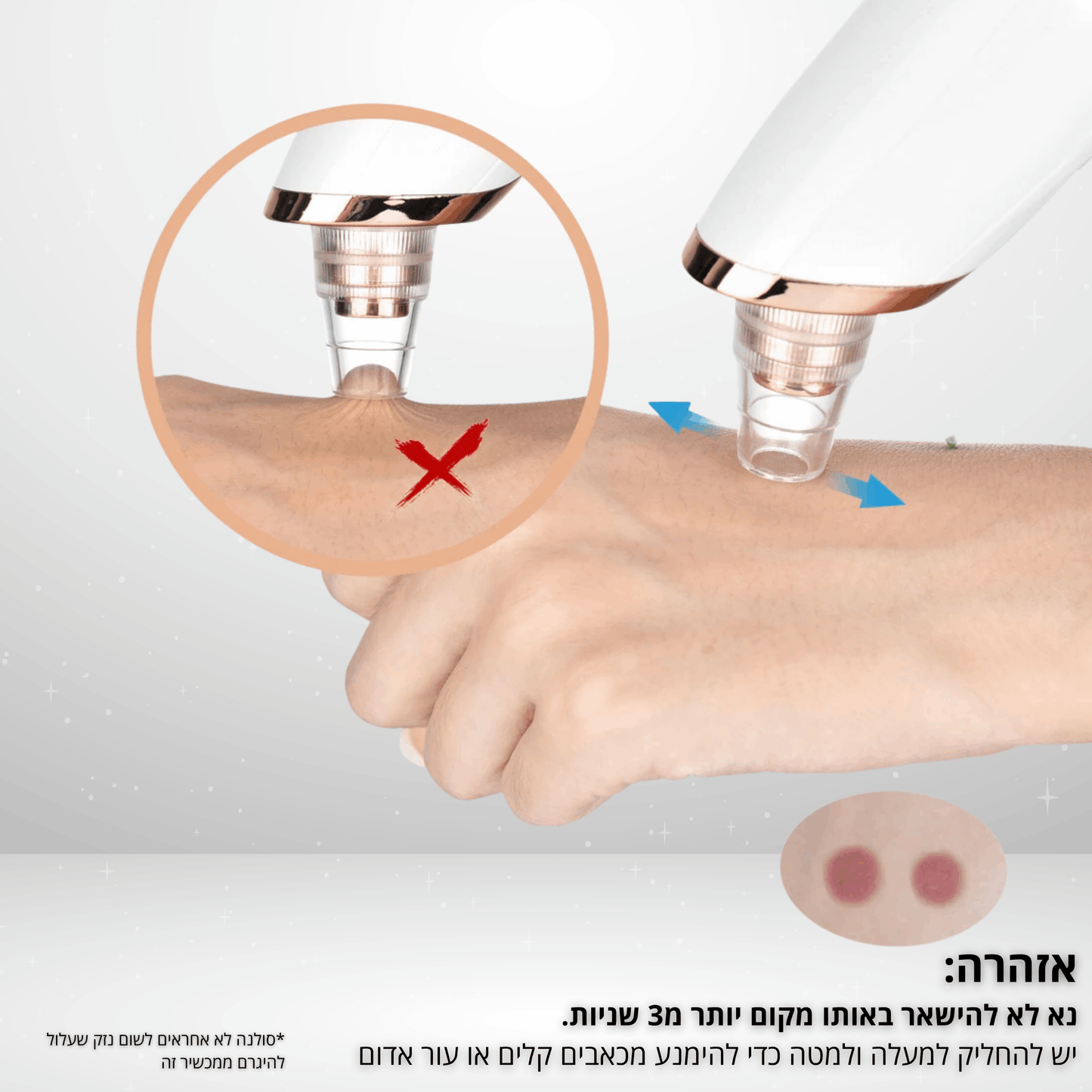 Solana™ – מכשיר ביתי להסרת שחורים