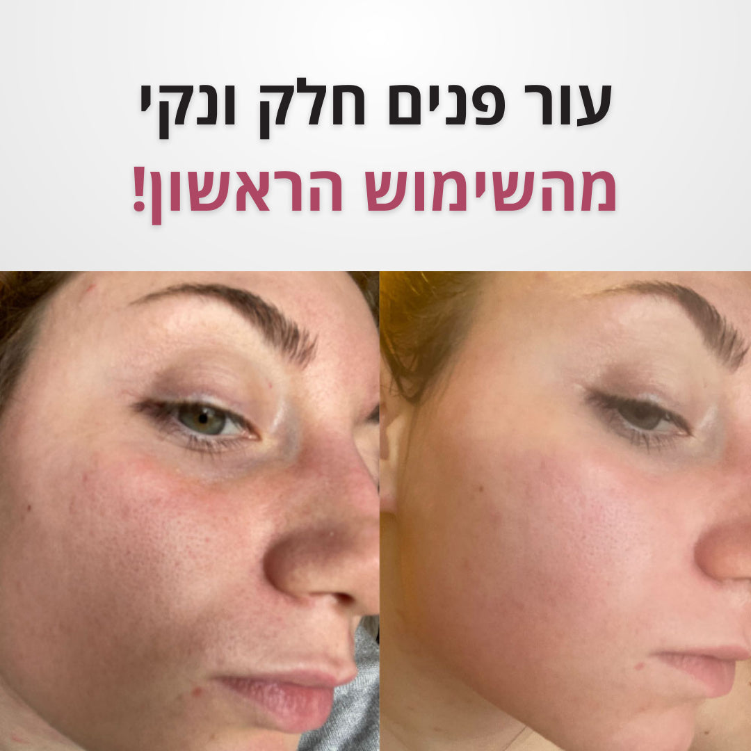 Solana™ – מכשיר ביתי להסרת שחורים