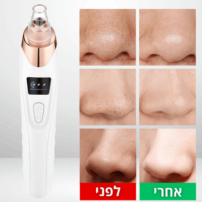 Solana™ – מכשיר ביתי להסרת שחורים